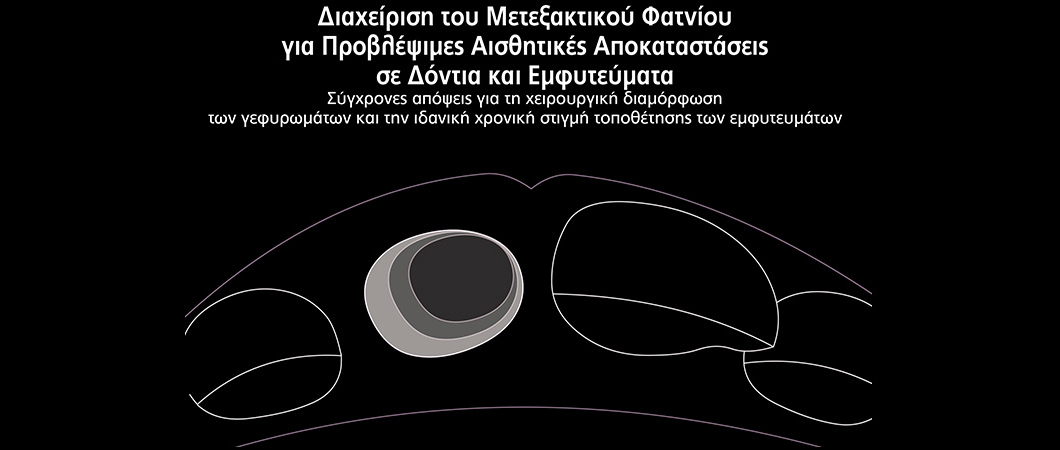 Διαχείριση του Μετεξακτικού Φατνίου για Προβλέψιμες Αισθητικές Αποκαταστάσεις σε Δόντια και Εμφυτεύματα - Omnipress