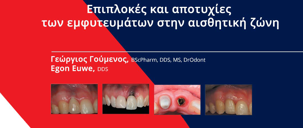 Επιπλοκές και αποτυχίες των εμφυτευμάτων στην αισθητική ζώνη - Omnipress