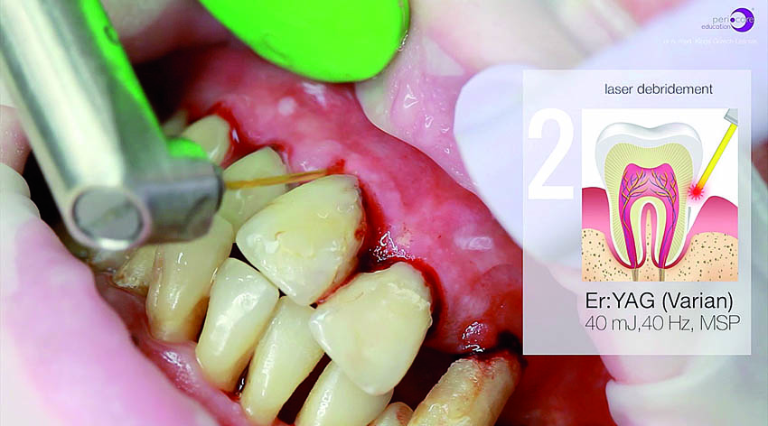 Αφαίρεση της υποουλικής τρυγίας