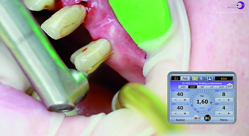 Αφαίρεση της υποουλικής τρυγίας