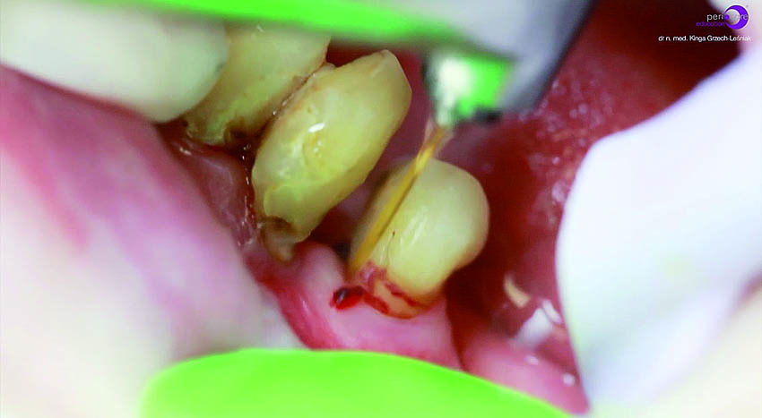 Αφαίρεση της υποουλικής τρυγίας