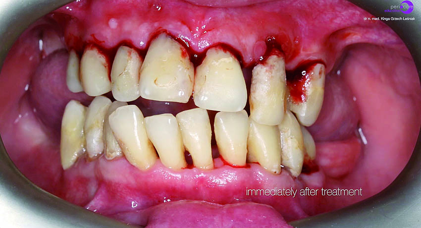 Κατάσταση αμέσως μετά την επέμβαση, την αφαίρεση της υποουλικής τρυγίας και την αποστείρωση των περιοδοντικών θυλάκων