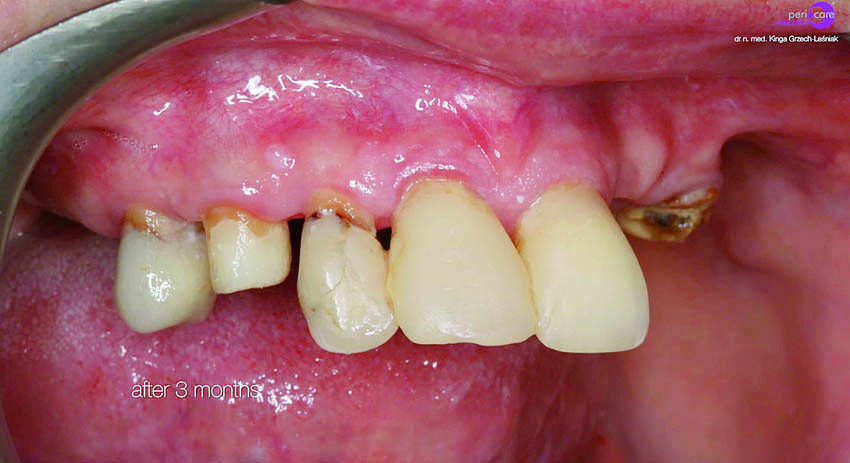 Κλινική εικόνα κατά την επανεξέταση στους τρεις και τους έξι μήνες