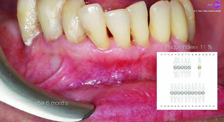 Κλινική εικόνα κατά την επανεξέταση στους τρεις και τους έξι μήνες