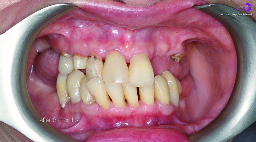 Κλινική εικόνα κατά την επανεξέταση στους τρεις και τους έξι μήνες