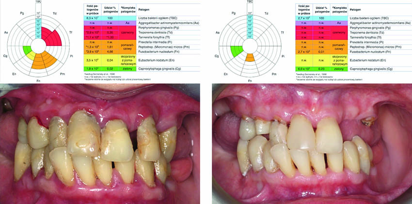Σύγκριση της κλινικής κατάστασης κατά την αρχική μοριακή-βιολογική εξέταση (Α) και την αντίστοιχη εξέταση στους έξι μήνες (Β)