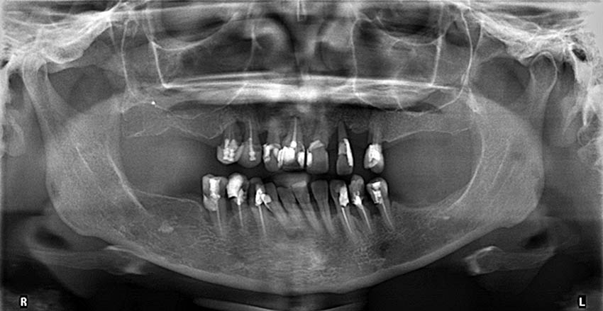 Εικόνα της πανοραμικής ακτινογραφίας
