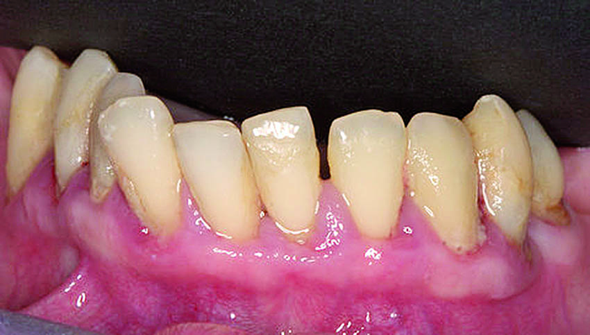 Η κατάσταση των δοντιών και των ούλων της κάτω γνάθου.