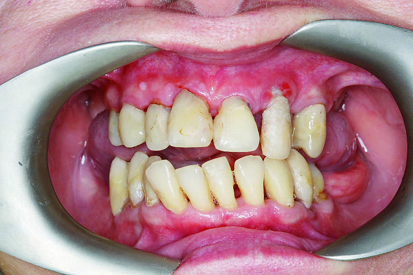 Κλινική βελτίωση των ούλων μετά τον καθαρισμό, με μείωση του οιδήματος, της αιμορραγίας και της βακτηριακής πλάκας