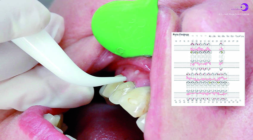 Κλινική εικόνα της περιοδοντικής θεραπείας με χρήση ηλεκτρονικής περιοδοντικής μήλης