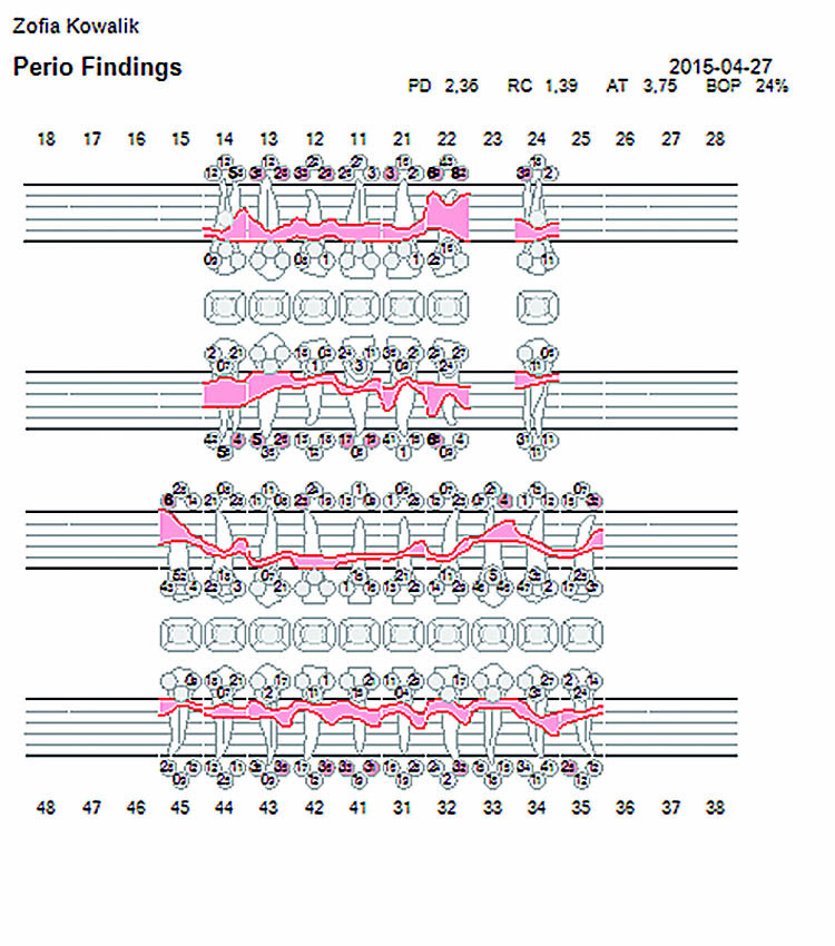 Τα αποτελέσματα της ανίχνευσης βάθους θυλάκων (ΒΘ), του επιπέδου κλινικής πρόσφυσης (ΕΚΠ) και της αιμορραγίας κατά την ανίχνευση (ΑΚΑ)