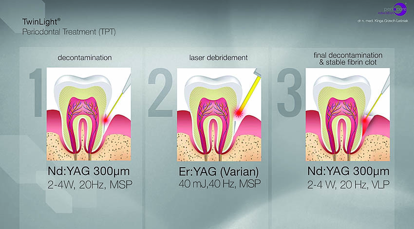 Αποστείρωση και απολύμανση των περιοδοντικών θυλάκων