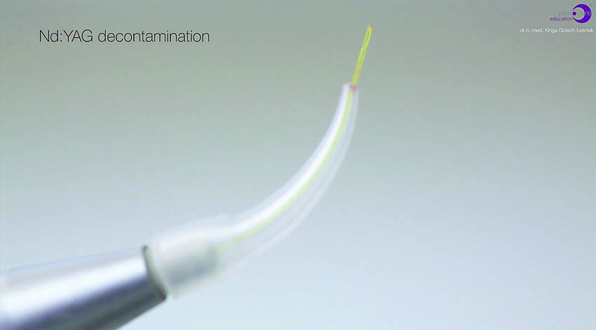 Αποστείρωση και απολύμανση των περιοδοντικών θυλάκων