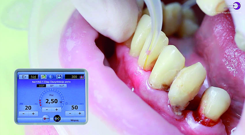 Αποστείρωση και απολύμανση των περιοδοντικών θυλάκων