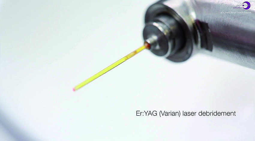 Αφαίρεση της υποουλικής τρυγίας