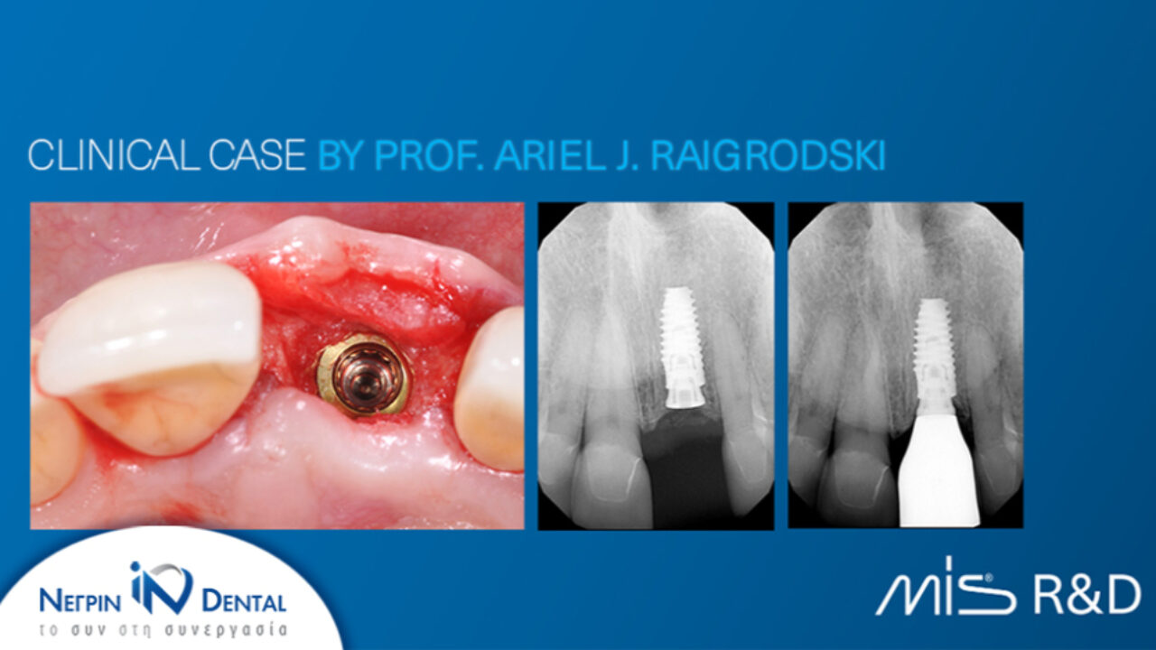 Παρουσίαση κλινικού περιστατικού του Prof. Raigrodski | MIS Academy