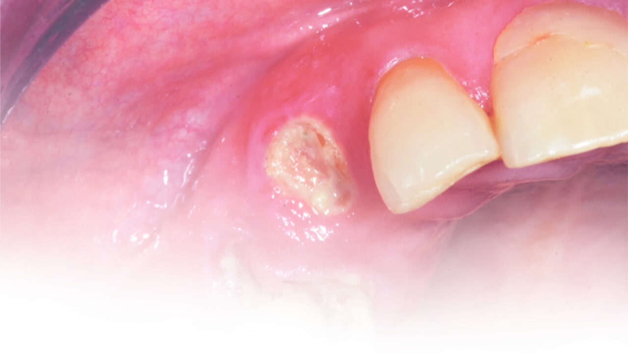 Κλινική χρήση του Biodentine™ σε πολφοτομές στα πρόσθια και οπίσθια νεογιλά δόντια, του Jarod W. Johnson, DDS