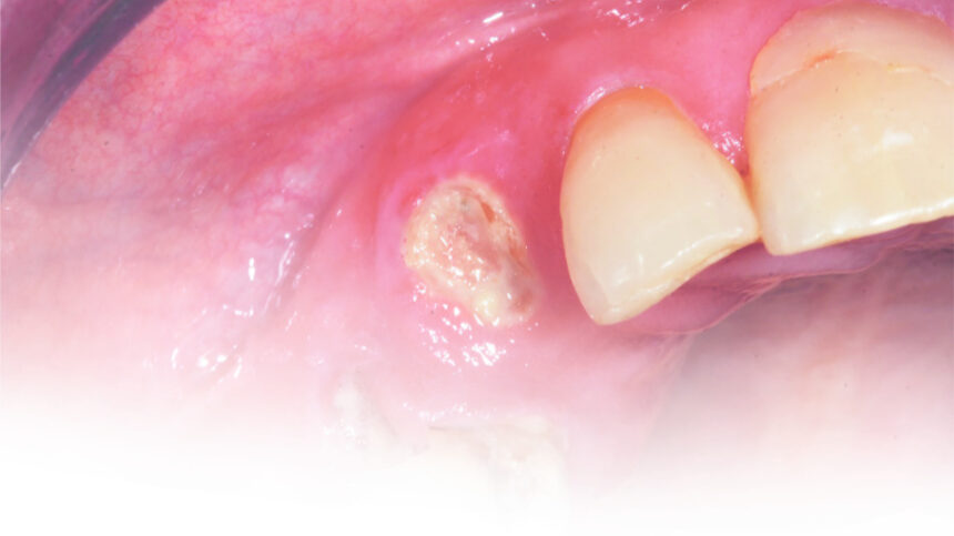 Κλινική χρήση του Biodentine™ σε πολφοτομές στα πρόσθια και οπίσθια νεογιλά δόντια, του Jarod W. Johnson, DDS