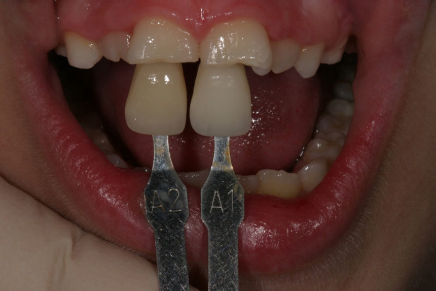 Σεμινάριο εκτεταμένων άμεσων αποκαταστάσεων σύνθετης ρητίνης Driving composite resins to their limits