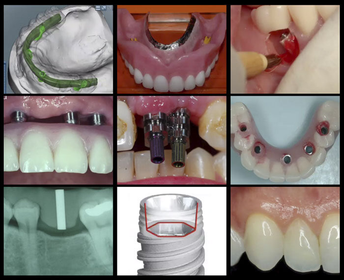 A-Z in Restorative Implant Dentistry