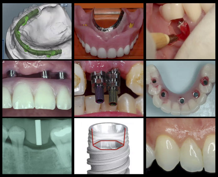 A-Z in Restorative Implant Dentistry