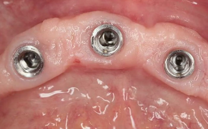 The Biologic Prosthetic Interface in Modern Esthetic Implantology - Revealing the Hidden Secrets of the Transgingival Part