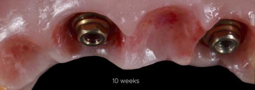 Χειρουργικά και προσθετικά πρωτόκολλα εμφυτευμάτων στην αισθητική ζώνη