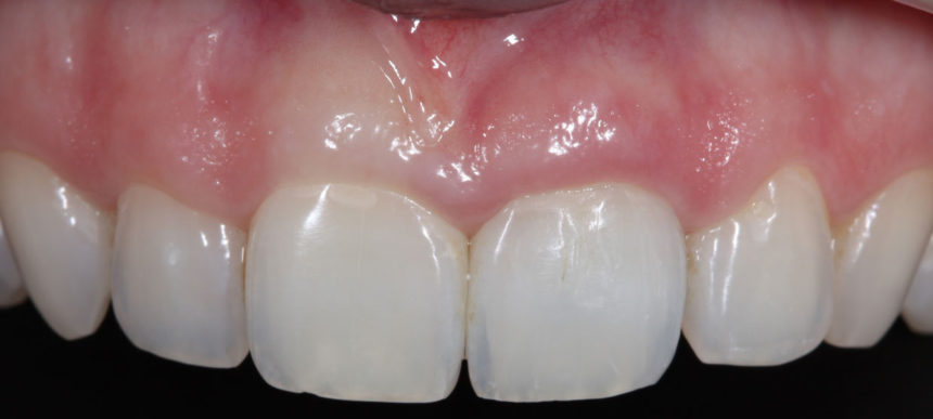 Νέα Χειρουργική Τεχνική ΑΜΕΣΗ ΟΔΟΝΤΟΦΑΤΝΙΑΚΗ ΑΠΟΚΑΤΑΣΤΑΣΗ - Άμεση φόρτιση εμφυτευμάτων σε προβληματικά φατνία - Εκπαιδευτής: Jose Carlos Martins Da Rosa