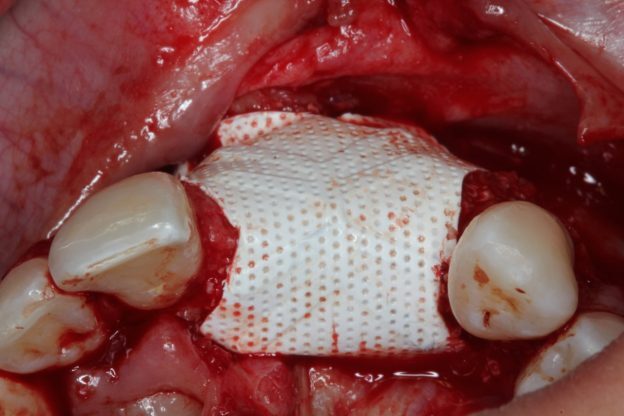 Guided Bone Regeneration - a 30-year Biological and Clinical Journey in Ridge Augmentation to Ensure Stable and Esthetic Implant Results