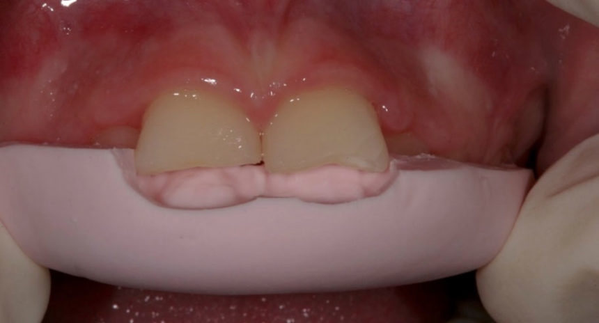 Σεμινάριο εκτεταμένων άμεσων αποκαταστάσεων σύνθετης ρητίνης Driving composite resins to their limits