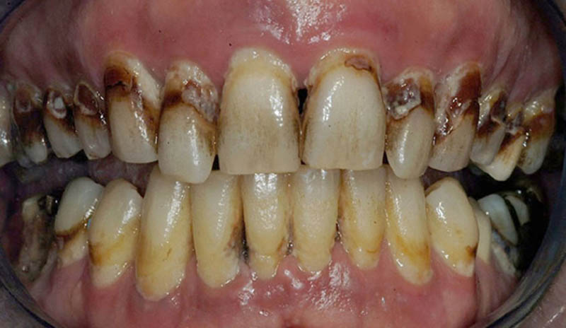 Αυτός ο ασθενής έχει περιοδοντικούς θύλακες με βάθος 6 χιλιοστά και περισσότερο. Υπάρχουν επίσης μεγάλες τερηδονικές βλάβες. Η διάσωση αυτών των δοντιών πιθανότατα δεν αποτελεί μία βιώσιμη λύση.