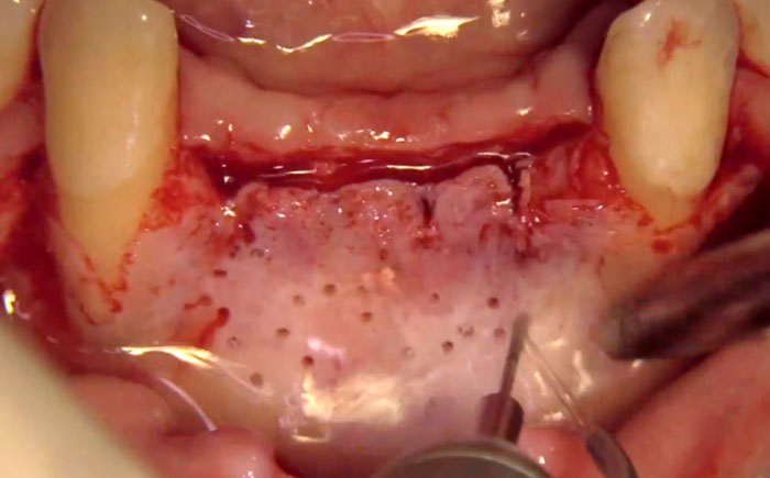 Hard & Soft Tissue Augmentation using GBR for Optimal Implant Esthetic & Long Term Success