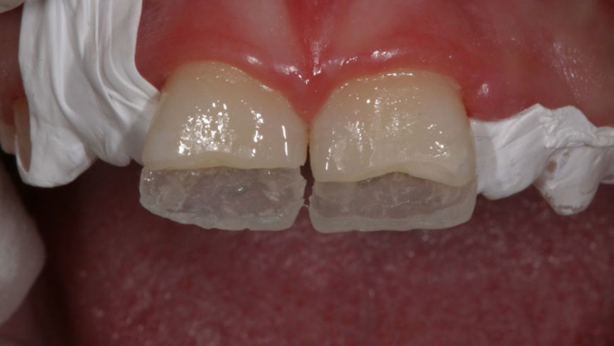 Σεμινάριο εκτεταμένων άμεσων αποκαταστάσεων σύνθετης ρητίνης Driving composite resins to their limits