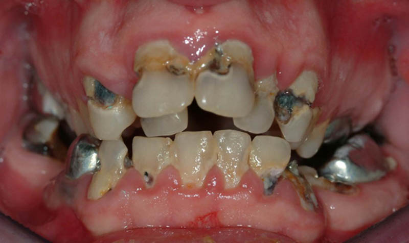 Αυτός ο νεαρός ασθενής έχει έντονες τερηδόνες, ανωμαλία σύγκλεισης και μέτρια περιοδοντική νόσο. Δεν αποτελεί έναν καλό υποψήφιο για τη διατήρηση των δοντιών.