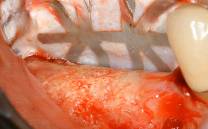 Benefits of the TR-Membrane in Vertical Ridge Augmentation