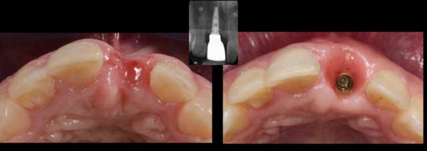Χειρουργικά και προσθετικά πρωτόκολλα εμφυτευμάτων στην αισθητική ζώνη
