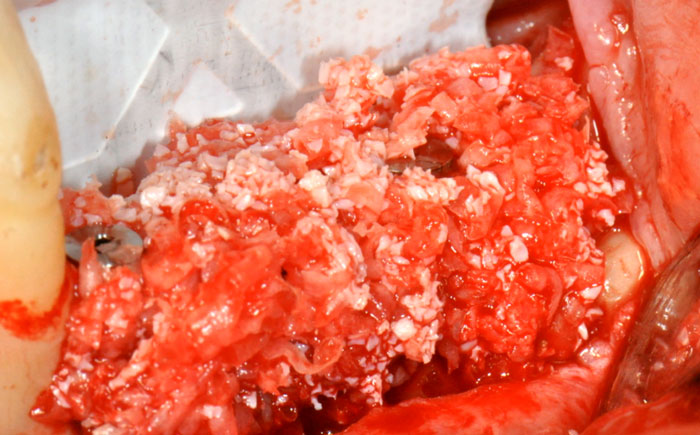 GBR Series (Part 1 of 4) - Surgical Approach