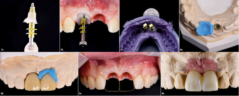 Προσθετική φάση
