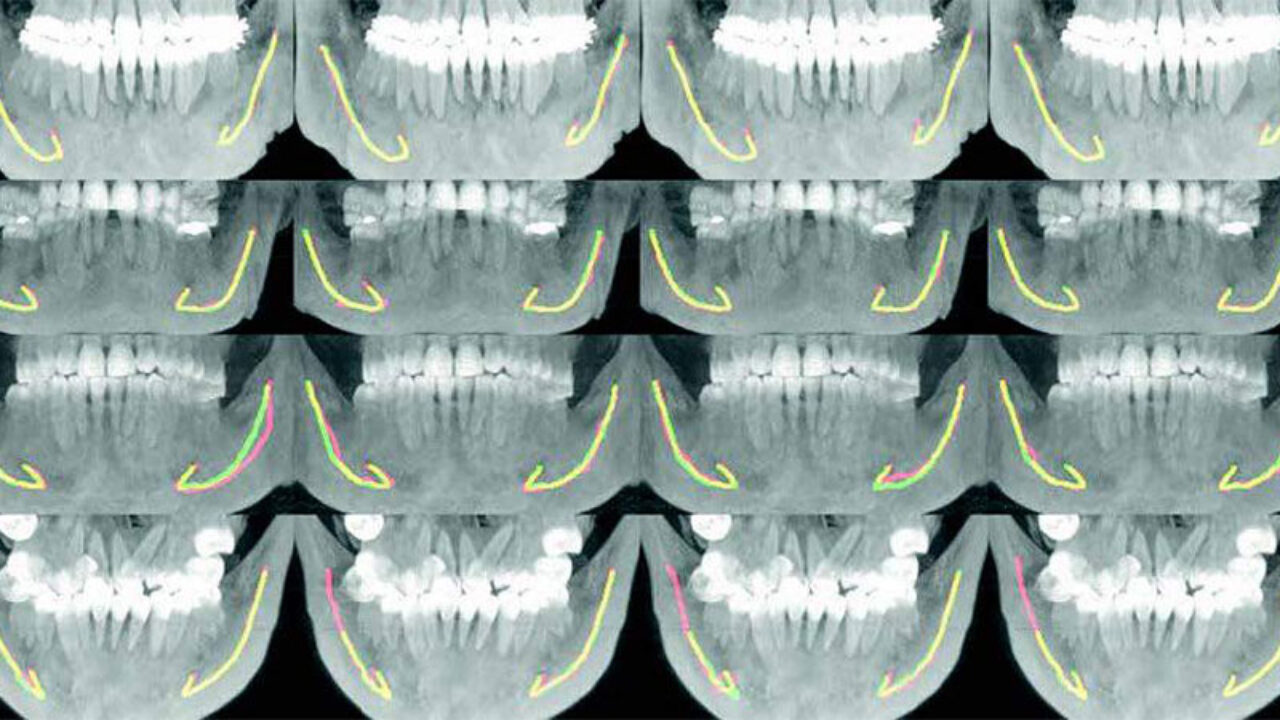 Η τεχνητή νοημοσύνη μπορεί να βοηθήσει στη χειρουργική των οδοντικών εμφυτευμάτων, εντοπίζοντας τον πόρο του κάτω φατνιακού νεύρου