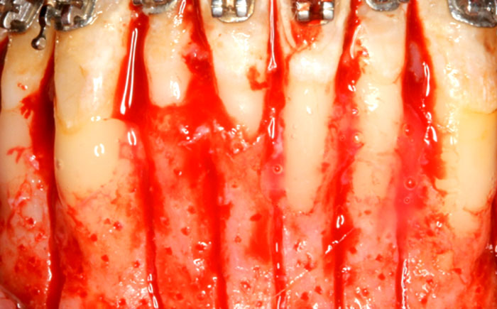 Surgically Facilitated Orthodontic Therapy - The Contemporary Approach to