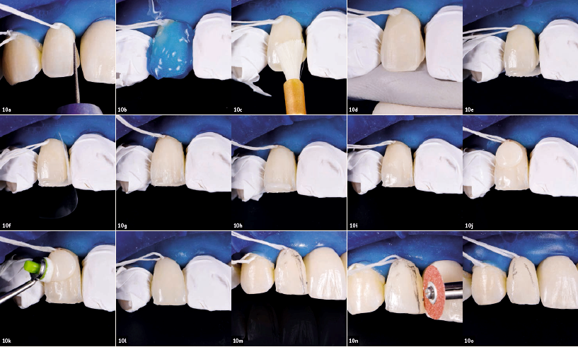 Προσθετική φάση