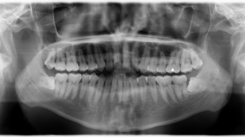 Ακτινογραφίες και καρκίνος του θυρεοειδή