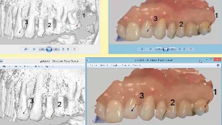 Προσωρινή αποκατάσταση με πλήρως ψηφιακή ροή