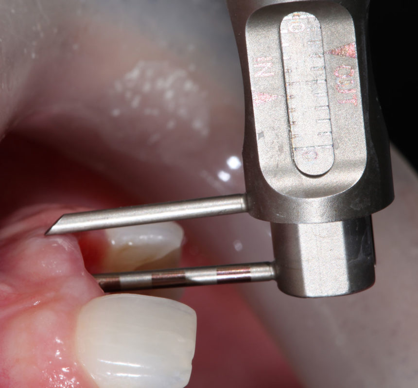 Νέα Χειρουργική Τεχνική ΑΜΕΣΗ ΟΔΟΝΤΟΦΑΤΝΙΑΚΗ ΑΠΟΚΑΤΑΣΤΑΣΗ - Άμεση φόρτιση εμφυτευμάτων σε προβληματικά φατνία - Εκπαιδευτής: Jose Carlos Martins Da Rosa