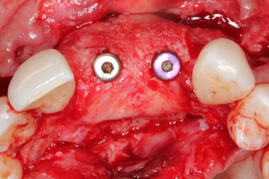 Κάθετη και οριζόντια αύξηση των σκληρών και μαλακών ιστών με τη χρήση κατευθυνόμενης οστικής αναγέννησης (GBR) - Εκπαιδευτής: Sascha Jovanovic