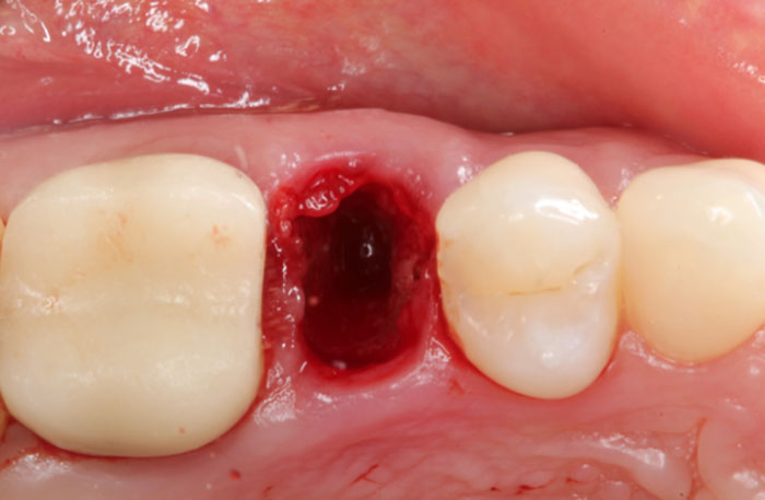 Extraction Socket - Preservation/Grafting; Immediate vs Delayed Implants; Pontic Site Development