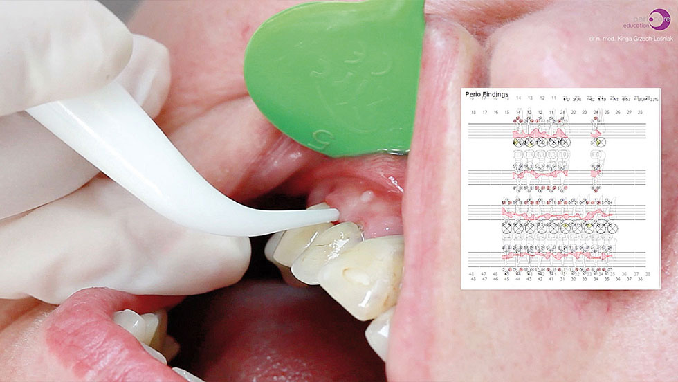 Περιοδοντολογία: Ένα θεραπευτικό πρωτόκολλο για τη θεραπεία περιοδοντικών θυλάκων