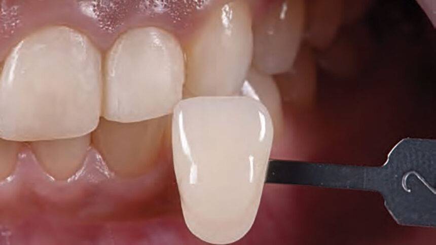 Βήμα προς βήμα το πρωτόκολλό VM9 που χρησιμοποιείται για την επίτευξη ιδανικού χρώματος, μορφολογίας και υφής στεφάνης στην αισθητική ζώνη