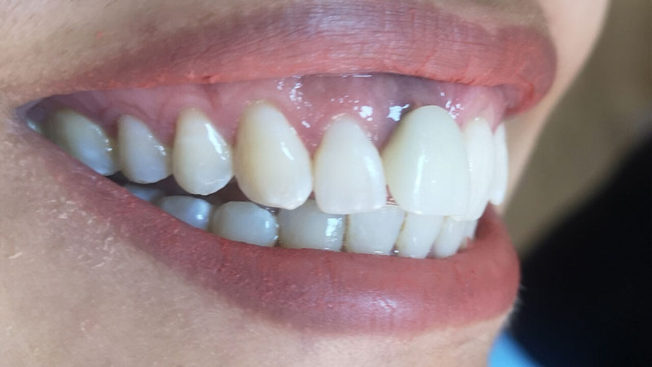 Όψεις και στεφάνη επί εμφυτεύματος ζιρκονίας από Ζιρκονία UTML ΚΑΤΑΝΑ, που συγκολλήθηκαν με PANAVIA Veneer LC