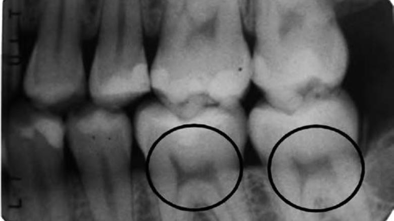 Οι οδοντιατρικές ακτινογραφίες μπορούν να αποκαλύψουν έλλειψη βιταμίνης D
